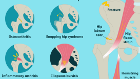 Causes And Treatments Of Hip Pain